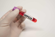 Qué pasa con la Viruela Símica (MPox) en la República Dominicana