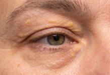 Manchas amarillas alrededor de los ojos podrían alertar sobre riesgos cardiovasculares