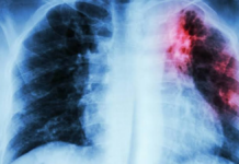 Más de la mitad de pacientes con fibrosis pulmonar en RD sigue sin tratamiento por barreras de acceso